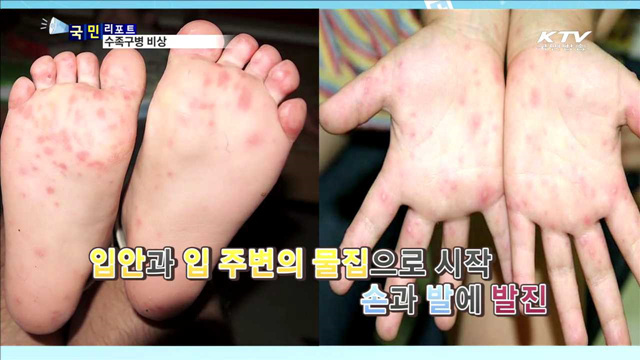 이른 더위 수족구병 확산…예방 방법은