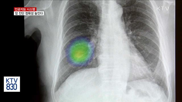 인공지능 시스템, 암 진단 정확성 높인다