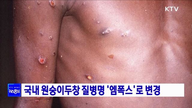 국내 원숭이두창 질병명 '엠폭스'로 변경