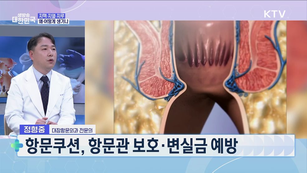 말 못할 고통 '치질'···예방부터 치료까지 [건강 365]