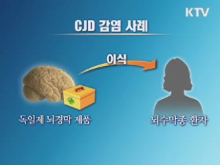 '광우병 증상' CJD 사망 첫 확인