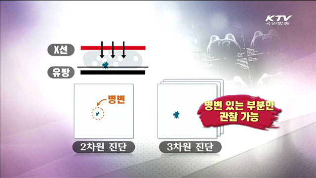 유방암 조기진단…'3차원 디지털 진단기기' 개발